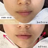 藻針  清粉刺  美容煥膚  肌膚健康養成  透白  零毛孔  痘痘剋星  坑洞救星  痘疤淡化 幹細胞科技  維珍娜藻針  安平做臉  台南清粉刺  台南做臉  無痛清粉刺  台南美容 台南做臉推薦  臉部雕塑  台南清痘痘  婚前保養