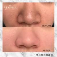 藻針  清粉刺  美容煥膚  肌膚健康養成  透白  零毛孔  痘痘剋星  坑洞救星  痘疤淡化 幹細胞科技  維珍娜藻針  安平做臉  台南清粉刺  台南做臉  無痛清粉刺  台南美容 台南做臉推薦  臉部雕塑  台南清痘痘  婚前保養