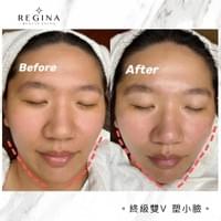 藻針  清粉刺  美容煥膚  肌膚健康養成  透白  零毛孔  痘痘剋星  坑洞救星  痘疤淡化 幹細胞科技  維珍娜藻針  安平做臉  台南清粉刺  台南做臉  無痛清粉刺  台南美容 台南做臉推薦  臉部雕塑  台南清痘痘  婚前保養