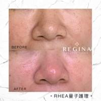 藻針  清粉刺  美容煥膚  肌膚健康養成  透白  零毛孔  痘痘剋星  坑洞救星  痘疤淡化 幹細胞科技  維珍娜藻針  安平做臉  台南清粉刺  台南做臉  無痛清粉刺  台南美容 台南做臉推薦  臉部雕塑  台南清痘痘  婚前保養