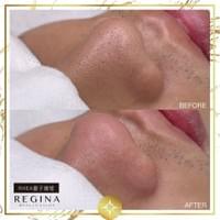 藻針  清粉刺  美容煥膚  肌膚健康養成  透白  零毛孔  痘痘剋星  坑洞救星  痘疤淡化 幹細胞科技  維珍娜藻針  安平做臉  台南清粉刺  台南做臉  無痛清粉刺  台南美容 台南做臉推薦  臉部雕塑  台南清痘痘  婚前保養