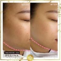 藻針  清粉刺  美容煥膚  肌膚健康養成  透白  零毛孔  痘痘剋星  坑洞救星  痘疤淡化 幹細胞科技  維珍娜藻針  安平做臉  台南清粉刺  台南做臉  無痛清粉刺  台南美容 台南做臉推薦  臉部雕塑  台南清痘痘  婚前保養