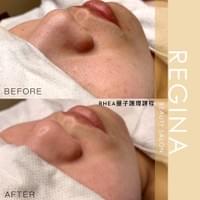 藻針  清粉刺  美容煥膚  肌膚健康養成  透白  零毛孔  痘痘剋星  坑洞救星  痘疤淡化 幹細胞科技  維珍娜藻針  安平做臉  台南清粉刺  台南做臉  無痛清粉刺  台南美容 台南做臉推薦  臉部雕塑  台南清痘痘  婚前保養