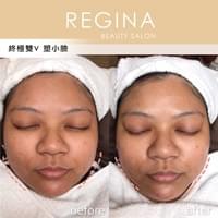 藻針  清粉刺  美容煥膚  肌膚健康養成  透白  零毛孔  痘痘剋星  坑洞救星  痘疤淡化 幹細胞科技  維珍娜藻針  安平做臉  台南清粉刺  台南做臉  無痛清粉刺  台南美容 台南做臉推薦  臉部雕塑  台南清痘痘  婚前保養