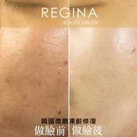 藻針  清粉刺  美容煥膚  肌膚健康養成  透白  零毛孔  痘痘剋星  坑洞救星  痘疤淡化 幹細胞科技  維珍娜藻針  安平做臉  台南清粉刺  台南做臉  無痛清粉刺  台南美容 台南做臉推薦  臉部雕塑  台南清痘痘  婚前保養