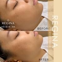 藻針  清粉刺  美容煥膚  肌膚健康養成  透白  零毛孔  痘痘剋星  坑洞救星  痘疤淡化 幹細胞科技  維珍娜藻針  安平做臉  台南清粉刺  台南做臉  無痛清粉刺  台南美容 台南做臉推薦  臉部雕塑  台南清痘痘  婚前保養