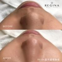 藻針  清粉刺  美容煥膚  肌膚健康養成  透白  零毛孔  痘痘剋星  坑洞救星  痘疤淡化 幹細胞科技  維珍娜藻針  安平做臉  台南清粉刺  台南做臉  無痛清粉刺  台南美容 台南做臉推薦  臉部雕塑  台南清痘痘  婚前保養