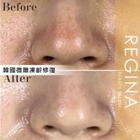 藻針  清粉刺  美容煥膚  肌膚健康養成  透白  零毛孔  痘痘剋星  坑洞救星  痘疤淡化 幹細胞科技  維珍娜藻針  安平做臉  台南清粉刺  台南做臉  無痛清粉刺  台南美容 台南做臉推薦  臉部雕塑  台南清痘痘  婚前保養