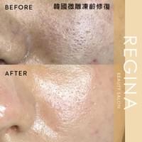 藻針  清粉刺  美容煥膚  肌膚健康養成  透白  零毛孔  痘痘剋星  坑洞救星  痘疤淡化 幹細胞科技  維珍娜藻針  安平做臉  台南清粉刺  台南做臉  無痛清粉刺  台南美容 台南做臉推薦  臉部雕塑  台南清痘痘  婚前保養