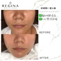 藻針  清粉刺  美容煥膚  肌膚健康養成  透白  零毛孔  痘痘剋星  坑洞救星  痘疤淡化 幹細胞科技  維珍娜藻針  安平做臉  台南清粉刺  台南做臉  無痛清粉刺  台南美容 台南做臉推薦  臉部雕塑  台南清痘痘  婚前保養