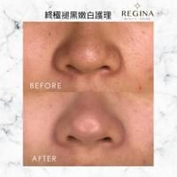 藻針  清粉刺  美容煥膚  肌膚健康養成  透白  零毛孔  痘痘剋星  坑洞救星  痘疤淡化 幹細胞科技  維珍娜藻針  安平做臉  台南清粉刺  台南做臉  無痛清粉刺  台南美容 台南做臉推薦  臉部雕塑  台南清痘痘  婚前保養