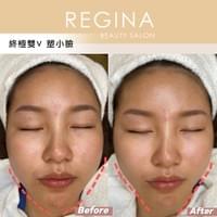 藻針  清粉刺  美容煥膚  肌膚健康養成  透白  零毛孔  痘痘剋星  坑洞救星  痘疤淡化 幹細胞科技  維珍娜藻針  安平做臉  台南清粉刺  台南做臉  無痛清粉刺  台南美容 台南做臉推薦  臉部雕塑  台南清痘痘  婚前保養