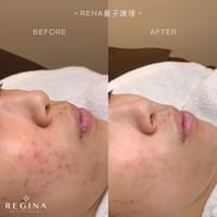 藻針  清粉刺  美容煥膚  肌膚健康養成  透白  零毛孔  痘痘剋星  坑洞救星  痘疤淡化 幹細胞科技  維珍娜藻針  安平做臉  台南清粉刺  台南做臉  無痛清粉刺  台南美容 台南做臉推薦  臉部雕塑  台南清痘痘  婚前保養