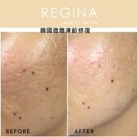 藻針  清粉刺  美容煥膚  肌膚健康養成  透白  零毛孔  痘痘剋星  坑洞救星  痘疤淡化 幹細胞科技  維珍娜藻針  安平做臉  台南清粉刺  台南做臉  無痛清粉刺  台南美容 台南做臉推薦  臉部雕塑  台南清痘痘  婚前保養