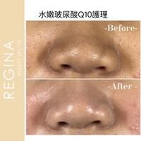 藻針  清粉刺  美容煥膚  肌膚健康養成  透白  零毛孔  痘痘剋星  坑洞救星  痘疤淡化 幹細胞科技  維珍娜藻針  安平做臉  台南清粉刺  台南做臉  無痛清粉刺  台南美容 台南做臉推薦  臉部雕塑  台南清痘痘  婚前保養