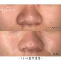 藻針  清粉刺  美容煥膚  肌膚健康養成  透白  零毛孔  痘痘剋星  坑洞救星  痘疤淡化 幹細胞科技  維珍娜藻針  安平做臉  台南清粉刺  台南做臉  無痛清粉刺  台南美容 台南做臉推薦  臉部雕塑  台南清痘痘  婚前保養