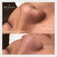 藻針  清粉刺  美容煥膚  肌膚健康養成  透白  零毛孔  痘痘剋星  坑洞救星  痘疤淡化 幹細胞科技  維珍娜藻針  安平做臉  台南清粉刺  台南做臉  無痛清粉刺  台南美容 台南做臉推薦  臉部雕塑  台南清痘痘  婚前保養