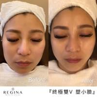 藻針  清粉刺  美容煥膚  肌膚健康養成  透白  零毛孔  痘痘剋星  坑洞救星  痘疤淡化 幹細胞科技  維珍娜藻針  安平做臉  台南清粉刺  台南做臉  無痛清粉刺  台南美容 台南做臉推薦  臉部雕塑  台南清痘痘  婚前保養