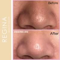 藻針  清粉刺  美容煥膚  肌膚健康養成  透白  零毛孔  痘痘剋星  坑洞救星  痘疤淡化 幹細胞科技  維珍娜藻針  安平做臉  台南清粉刺  台南做臉  無痛清粉刺  台南美容 台南做臉推薦  臉部雕塑  台南清痘痘  婚前保養