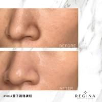 藻針  清粉刺  美容煥膚  肌膚健康養成  透白  零毛孔  痘痘剋星  坑洞救星  痘疤淡化 幹細胞科技  維珍娜藻針  安平做臉  台南清粉刺  台南做臉  無痛清粉刺  台南美容 台南做臉推薦  臉部雕塑  台南清痘痘  婚前保養