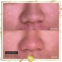 藻針  清粉刺  美容煥膚  肌膚健康養成  透白  零毛孔  痘痘剋星  坑洞救星  痘疤淡化 幹細胞科技  維珍娜藻針  安平做臉  台南清粉刺  台南做臉  無痛清粉刺  台南美容 台南做臉推薦  臉部雕塑  台南清痘痘  婚前保養