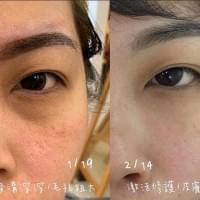 淚溝  蘋果肌  法令紋  夫妻宮  木偶紋  川字紋  下巴  激活填補  凹陷填補  維珍娜  無針 無麻藥  無傷口