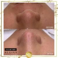 藻針  清粉刺  美容煥膚  肌膚健康養成  透白  零毛孔  痘痘剋星  坑洞救星  痘疤淡化 幹細胞科技  維珍娜藻針  安平做臉  台南清粉刺  台南做臉  無痛清粉刺  台南美容 台南做臉推薦  臉部雕塑  台南清痘痘  婚前保養