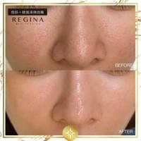 藻針  清粉刺  美容煥膚  肌膚健康養成  透白  零毛孔  痘痘剋星  坑洞救星  痘疤淡化 幹細胞科技  維珍娜藻針  安平做臉  台南清粉刺  台南做臉  無痛清粉刺  台南美容 台南做臉推薦  臉部雕塑  台南清痘痘  婚前保養