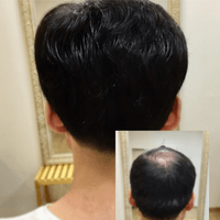 男士頭頂稀疏補髮後腦對照