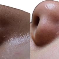 #莯洸美學 #矽幻膚 #清粉刺 #藻針 #美背 #緊緻V臉