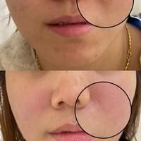 #莯洸美學 #矽幻膚 #清粉刺 #藻針 #美背 #緊緻V臉