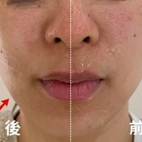 #莯洸美學 #矽幻膚 #清粉刺 #藻針 #美背 #緊緻V臉