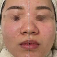 #莯洸美學 #矽幻膚 #清粉刺 #藻針 #美背 #緊緻V臉