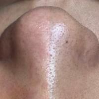 #莯洸美學 #矽幻膚 #清粉刺 #藻針 #美背 #緊緻V臉