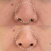 #莯洸美學 #矽幻膚 #清粉刺 #藻針 #美背 #緊緻V臉