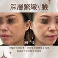 #莯洸美學 美容區 深層緊緻V臉