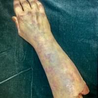 SEVERED ROTTING ARM