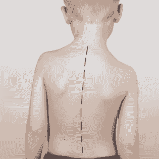 Scoliosis in Children