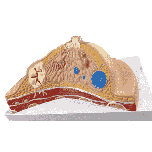 Pathological Breast Model Human Anatomic Medical Model Anatomical Teaching Tool Learning Display Aid
