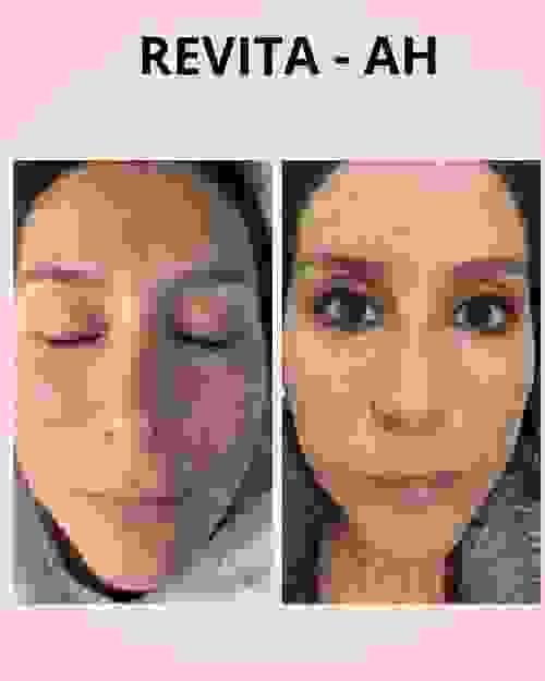 Microneedling /dermapen (microagujas)