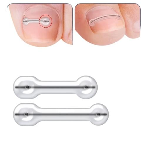Titanium Alloy Ingrown Toenail Treatment Nail Tools (0.67/0.79in)