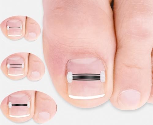 Titanium Alloy Ingrown Toenail Treatment & Removal Kit for Quick Relief, Ingrown Toenail Removal Kit