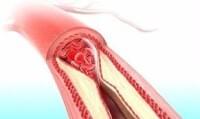 尿酸冠狀動脈鈣化 | Uric Acid Coronary Calcification