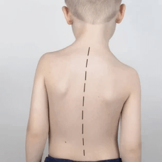Scoliosis in Children