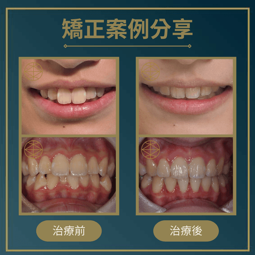 矯正案例分享