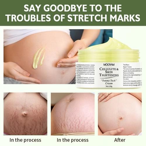 Stretch Mark Removal Cream 120g