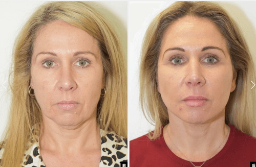 9L Facelift & Neck Lift