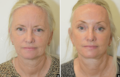 9L facelift and blepharoplasty
