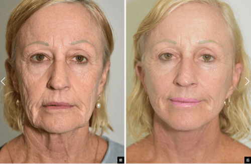 9L facelift, blepharoplasty (eyelid lift), neck lift