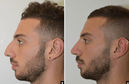 Male rhinoplasty
